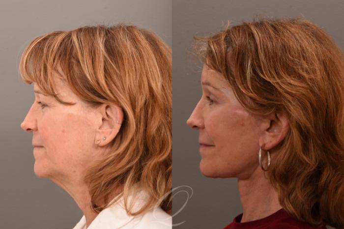 Facelift Case 1001749 Before & After Left Side | Serving Rochester, Syracuse & Buffalo, NY | Quatela Center for Plastic Surgery