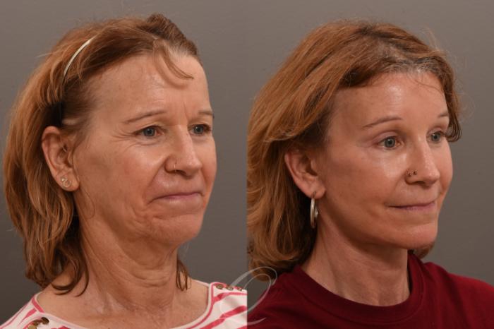 Facelift Case 1001749 Before & After Right Oblique | Serving Rochester, Syracuse & Buffalo, NY | Quatela Center for Plastic Surgery