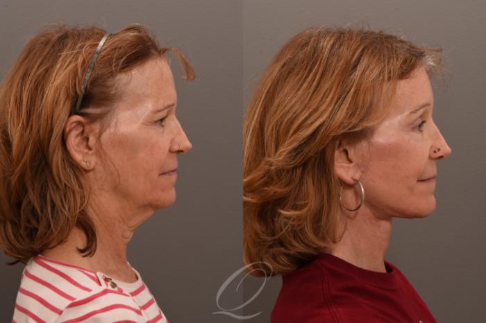 Facelift Case 1001749 Before & After Right Side | Serving Rochester, Syracuse & Buffalo, NY | Quatela Center for Plastic Surgery