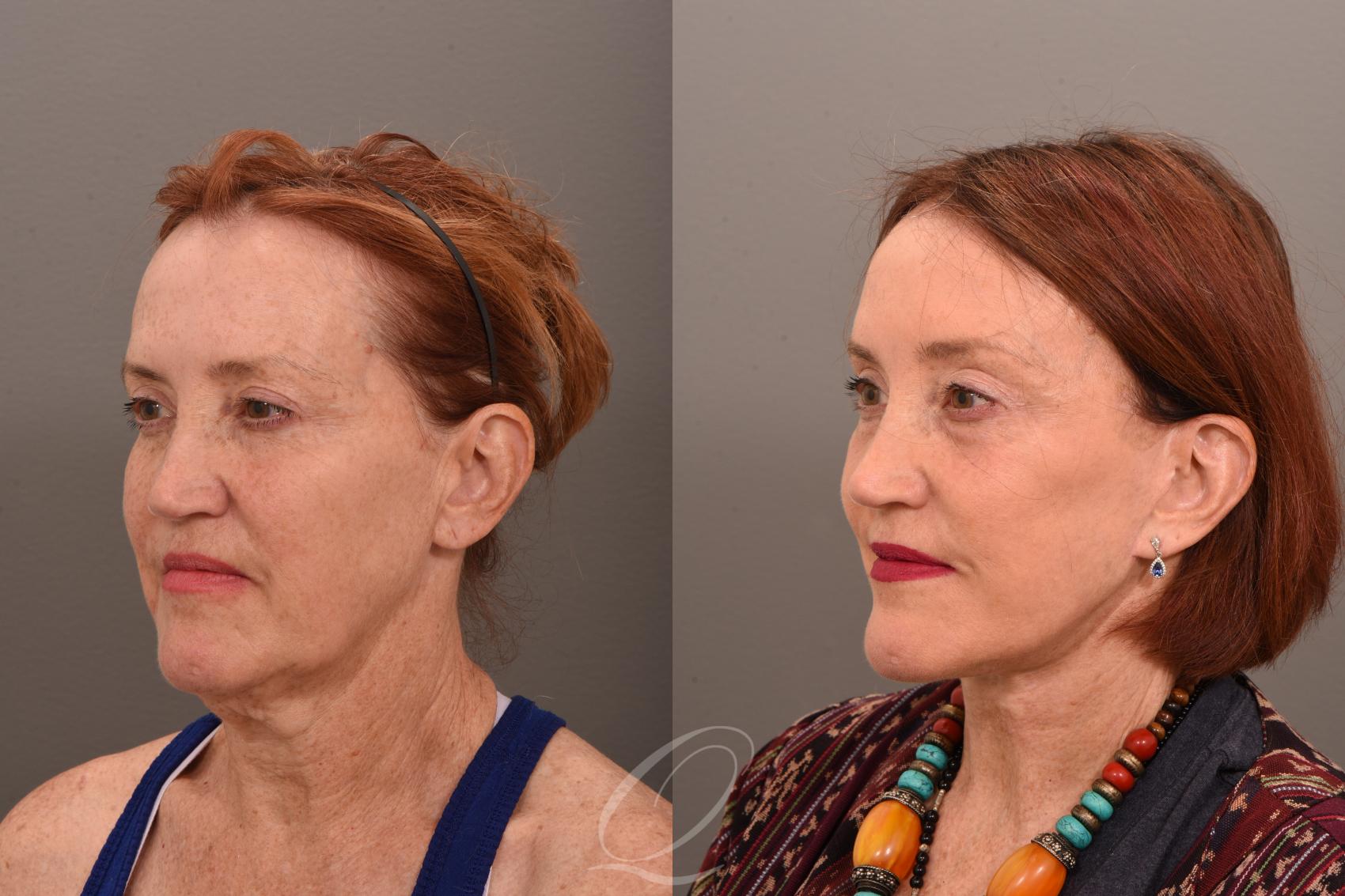 Fat Injections Case 1001751 Before & After Left Oblique | Serving Rochester, Syracuse & Buffalo, NY | Quatela Center for Plastic Surgery