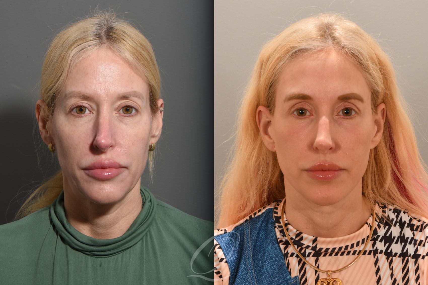 Facelift Case 1001760 Before & After Front | Serving Rochester, Syracuse & Buffalo, NY | Quatela Center for Plastic Surgery