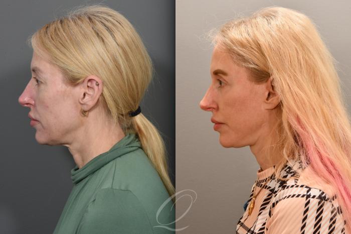 Skin Resurfacing Case 1001760 Before & After Left Side | Serving Rochester, Syracuse & Buffalo, NY | Quatela Center for Plastic Surgery