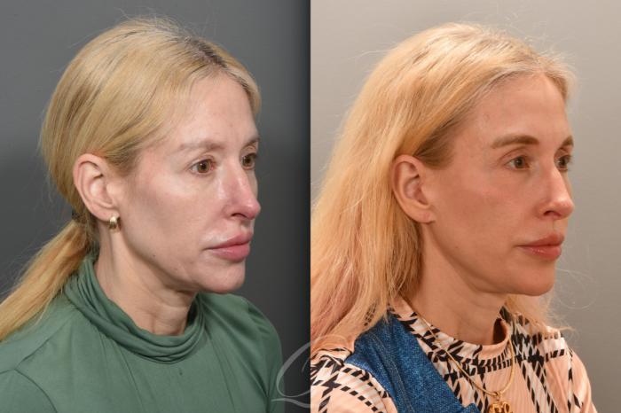 Facelift Case 1001760 Before & After Right Oblique | Serving Rochester, Syracuse & Buffalo, NY | Quatela Center for Plastic Surgery