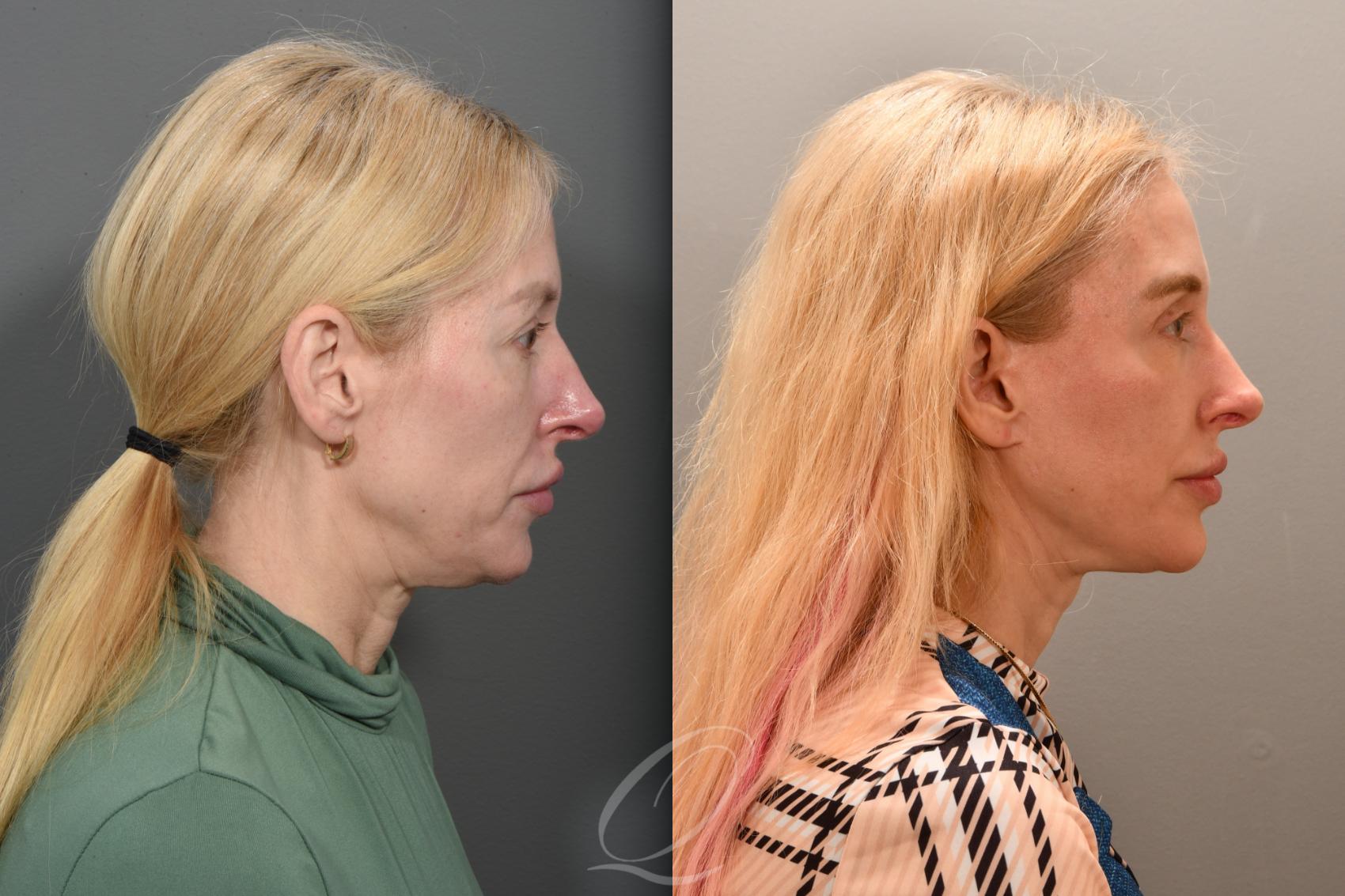 Skin Resurfacing Case 1001760 Before & After Right Side | Serving Rochester, Syracuse & Buffalo, NY | Quatela Center for Plastic Surgery