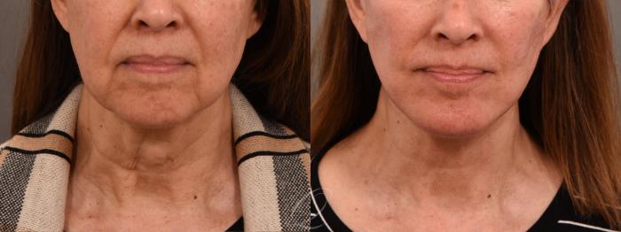 Facelift Case 1001774 Before & After Front | Serving Rochester, Syracuse & Buffalo, NY | Quatela Center for Plastic Surgery