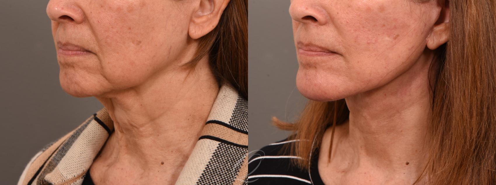 Facelift Case 1001774 Before & After Left Oblique | Serving Rochester, Syracuse & Buffalo, NY | Quatela Center for Plastic Surgery