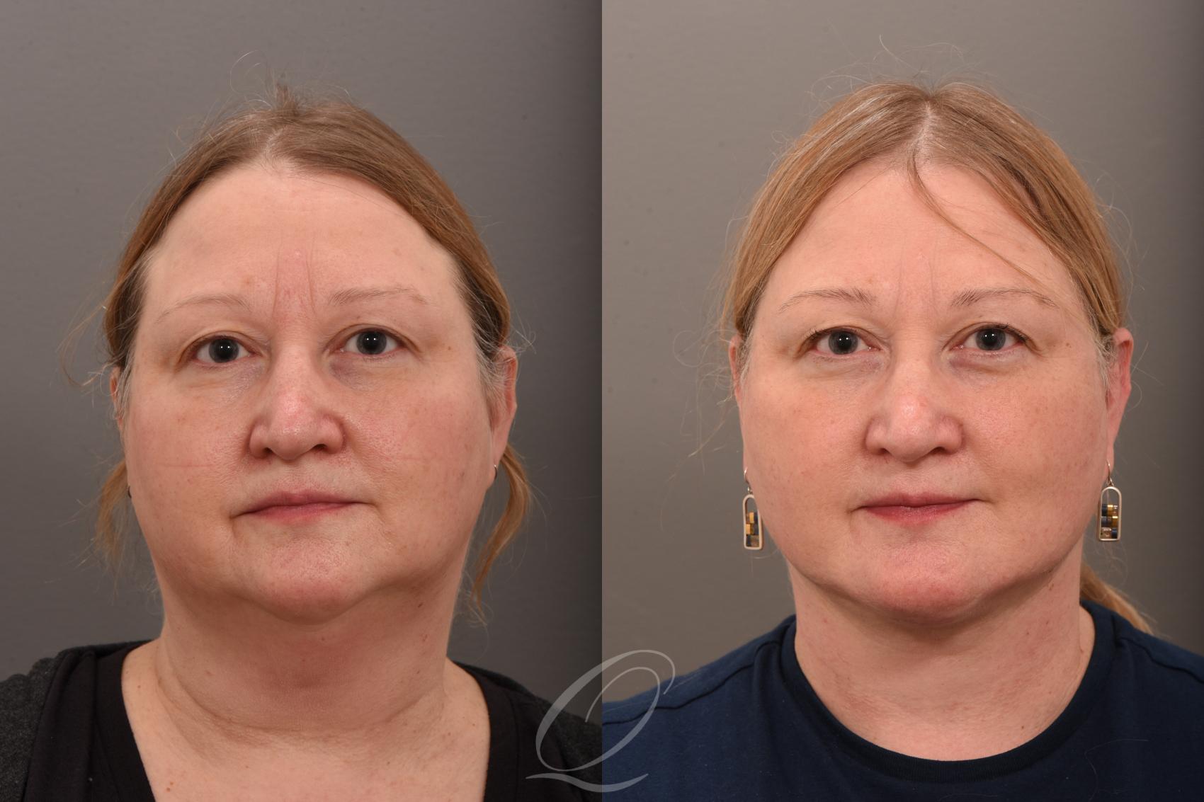 Facelift Case 1001776 Before & After Front | Serving Rochester, Syracuse & Buffalo, NY | Quatela Center for Plastic Surgery