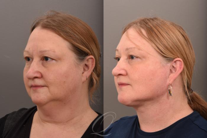 Facelift Case 1001776 Before & After Left Oblique | Serving Rochester, Syracuse & Buffalo, NY | Quatela Center for Plastic Surgery