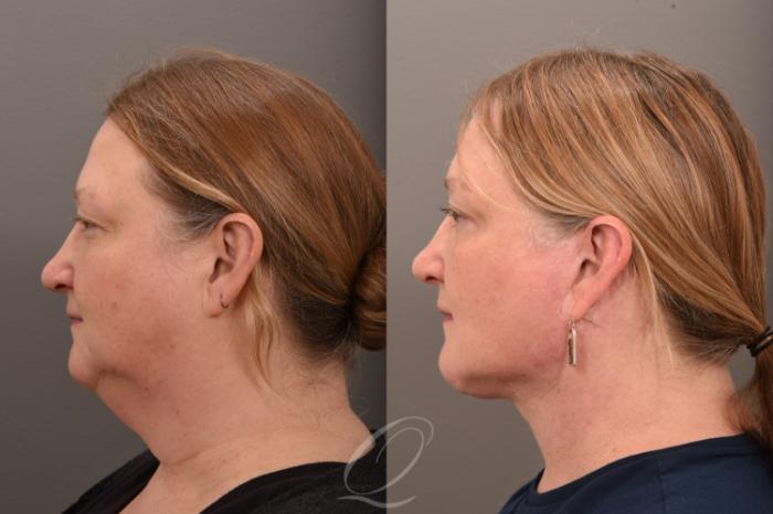 Facelift Case 1001776 Before & After Left Side | Serving Rochester, Syracuse & Buffalo, NY | Quatela Center for Plastic Surgery