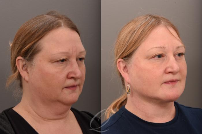 Facelift Case 1001776 Before & After Right Oblique | Serving Rochester, Syracuse & Buffalo, NY | Quatela Center for Plastic Surgery