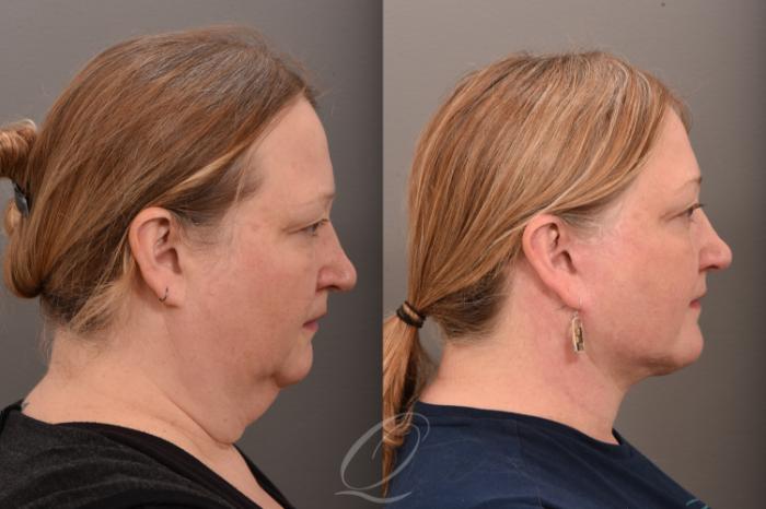 Facelift Case 1001776 Before & After Right Side | Serving Rochester, Syracuse & Buffalo, NY | Quatela Center for Plastic Surgery