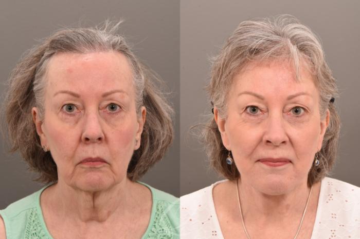 Facelift Case 1001777 Before & After Front | Serving Rochester, Syracuse & Buffalo, NY | Quatela Center for Plastic Surgery