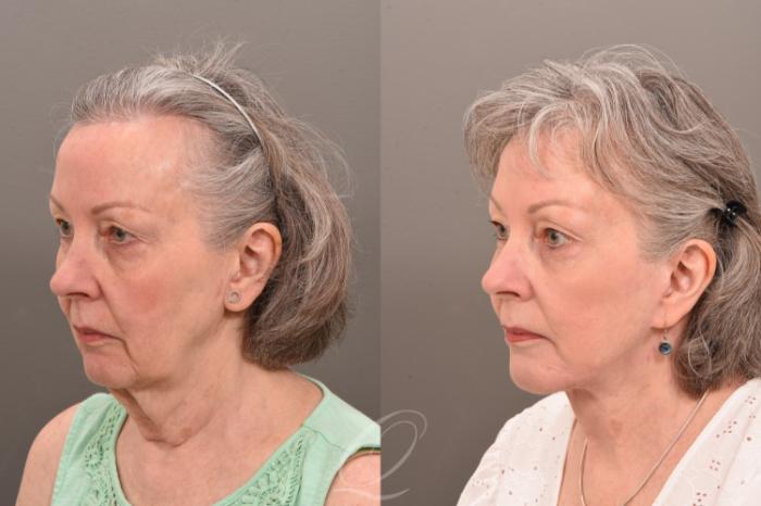 Facelift Case 1001777 Before & After Left Oblique | Serving Rochester, Syracuse & Buffalo, NY | Quatela Center for Plastic Surgery