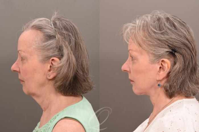 Facelift Case 1001777 Before & After Left Side | Serving Rochester, Syracuse & Buffalo, NY | Quatela Center for Plastic Surgery