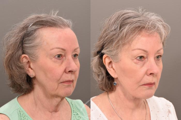 Facelift Case 1001777 Before & After Right Oblique | Serving Rochester, Syracuse & Buffalo, NY | Quatela Center for Plastic Surgery