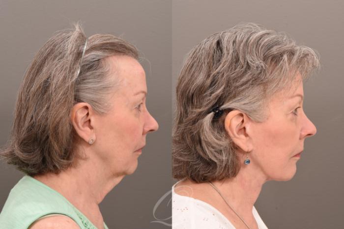 Facelift Case 1001777 Before & After Right Side | Serving Rochester, Syracuse & Buffalo, NY | Quatela Center for Plastic Surgery