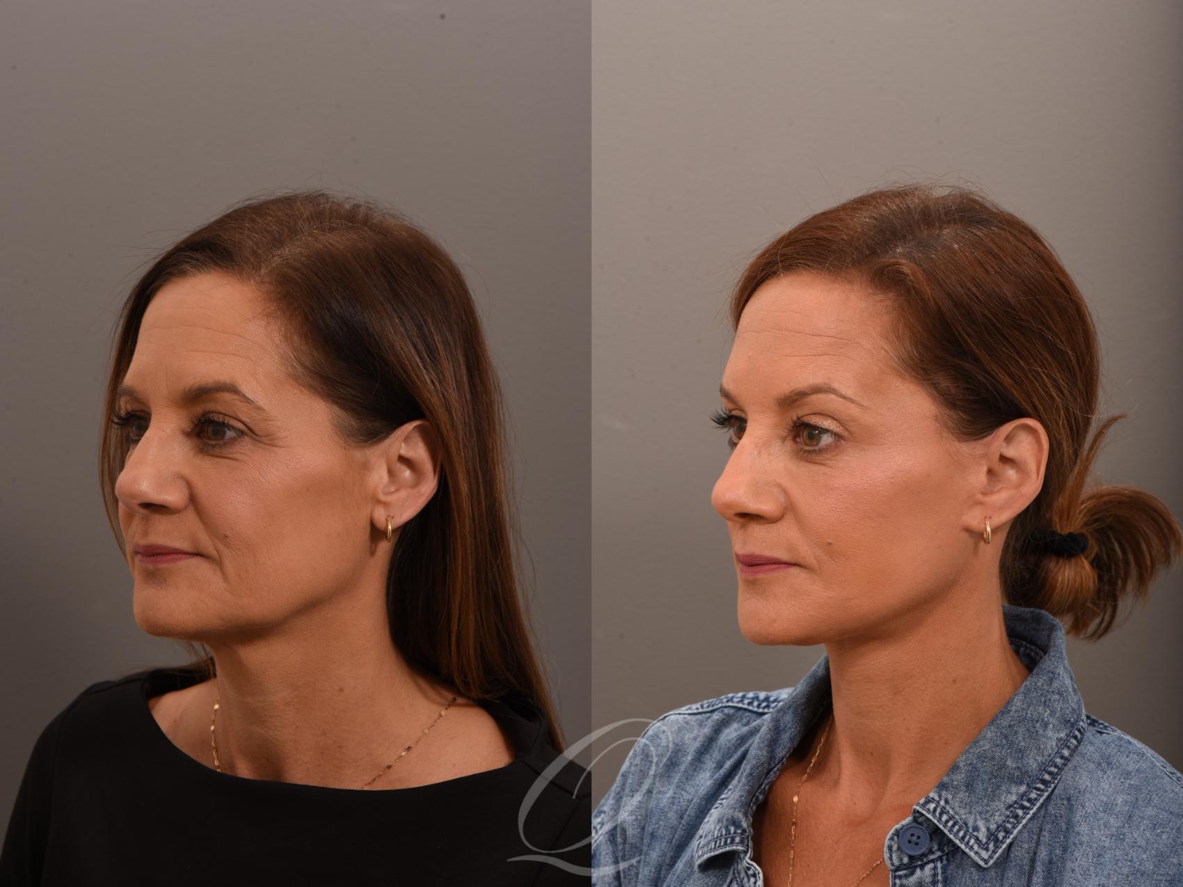 Facelift Case 1001797 Before & After Left Oblique | Serving Rochester, Syracuse & Buffalo, NY | Quatela Center for Plastic Surgery