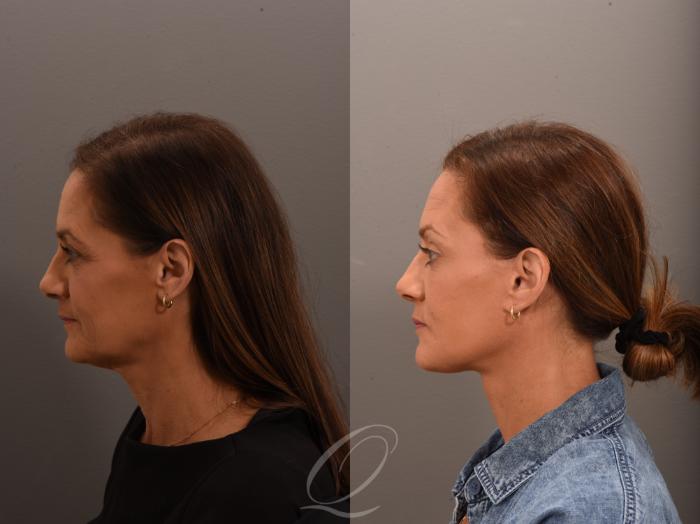 Facelift Case 1001797 Before & After Left Side | Serving Rochester, Syracuse & Buffalo, NY | Quatela Center for Plastic Surgery