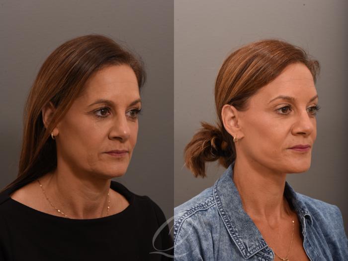 Facelift Case 1001797 Before & After Right Oblique | Serving Rochester, Syracuse & Buffalo, NY | Quatela Center for Plastic Surgery