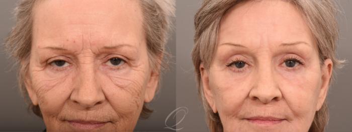 Facelift Case 1001800 Before & After Close Up | Serving Rochester, Syracuse & Buffalo, NY | Quatela Center for Plastic Surgery