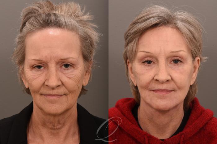 Facelift Case 1001800 Before & After Front | Serving Rochester, Syracuse & Buffalo, NY | Quatela Center for Plastic Surgery