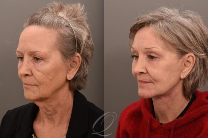 Facelift Case 1001800 Before & After Left Oblique | Serving Rochester, Syracuse & Buffalo, NY | Quatela Center for Plastic Surgery