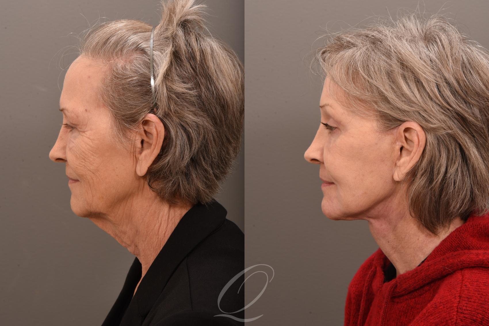 Facelift Case 1001800 Before & After Left Side | Serving Rochester, Syracuse & Buffalo, NY | Quatela Center for Plastic Surgery