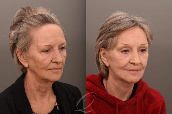 Facelift Case 1001800 Before & After Right Oblique | Serving Rochester, Syracuse & Buffalo, NY | Quatela Center for Plastic Surgery