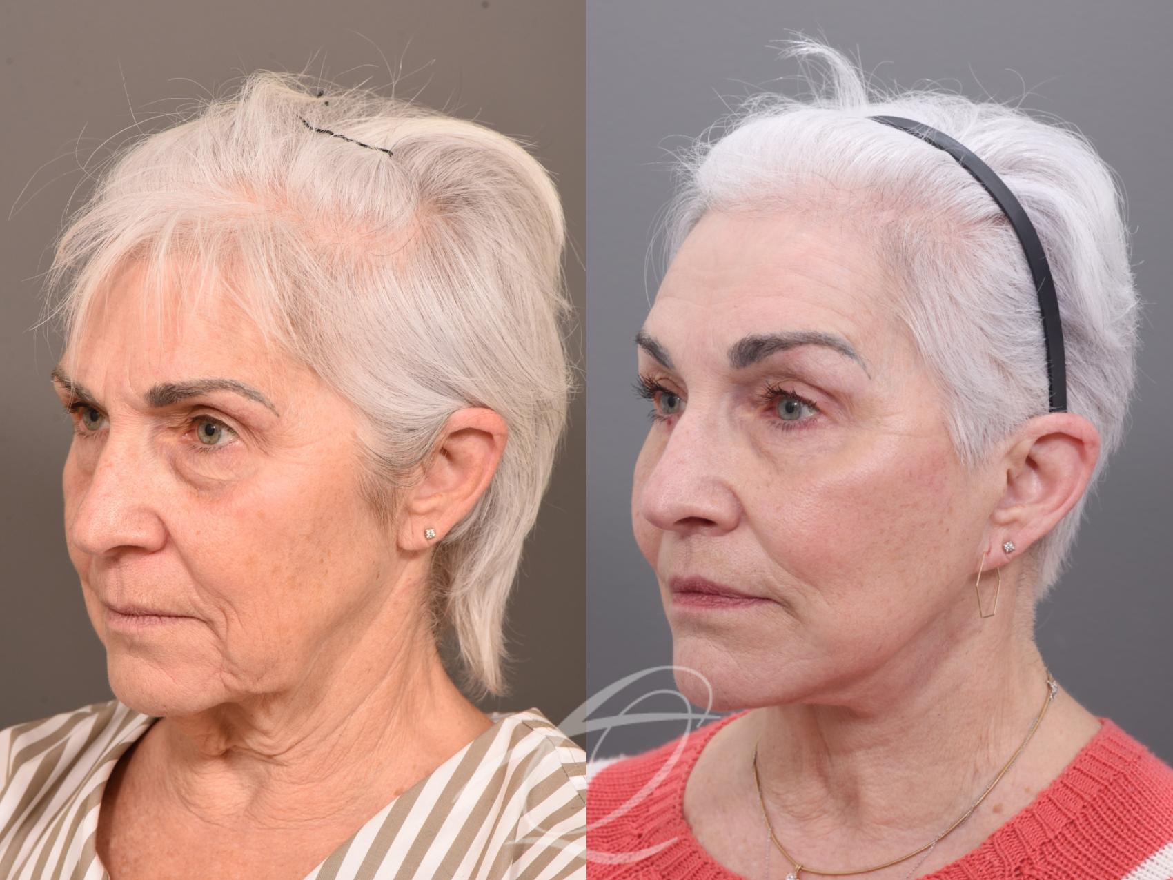 Facelift Case 1001822 Before & After Left Oblique | Serving Rochester, Syracuse & Buffalo, NY | Quatela Center for Plastic Surgery