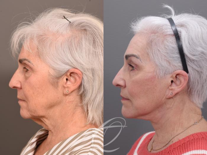 Facelift Case 1001822 Before & After Left Side | Serving Rochester, Syracuse & Buffalo, NY | Quatela Center for Plastic Surgery