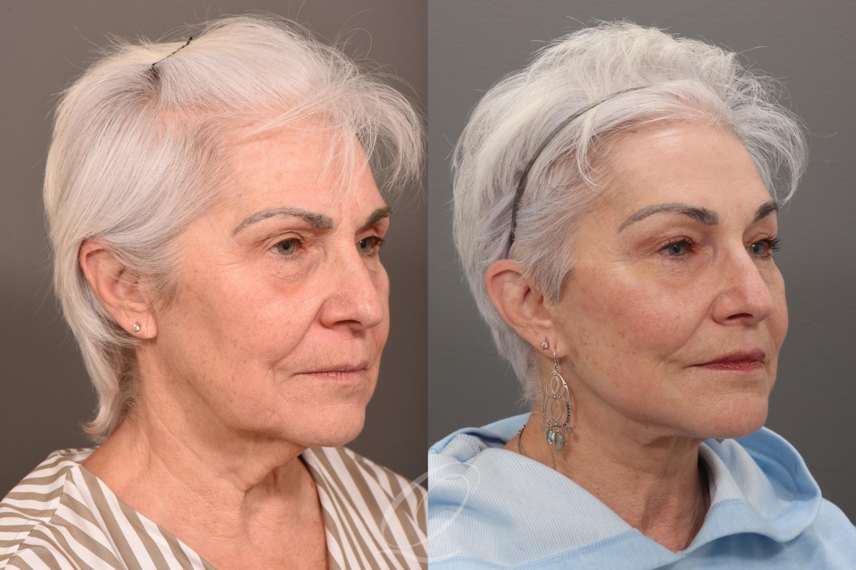 Skin Resurfacing Case 1001822 Before & After Right Oblique | Serving Rochester, Syracuse & Buffalo, NY | Quatela Center for Plastic Surgery