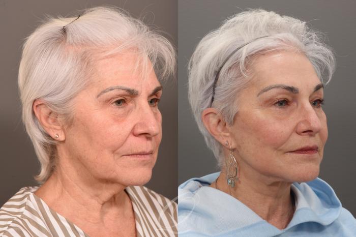 Skin Resurfacing Case 1001822 Before & After Right Oblique | Serving Rochester, Syracuse & Buffalo, NY | Quatela Center for Plastic Surgery
