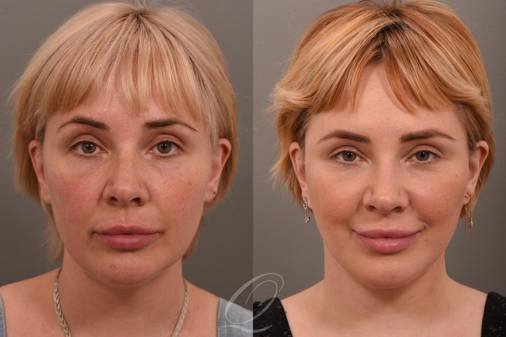 Facelift Case 1001849 Before & After Front | Serving Rochester, Syracuse & Buffalo, NY | Quatela Center for Plastic Surgery