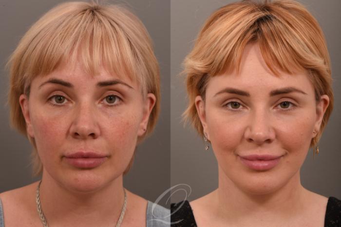 Facelift Case 1001849 Before & After Front | Serving Rochester, Syracuse & Buffalo, NY | Quatela Center for Plastic Surgery