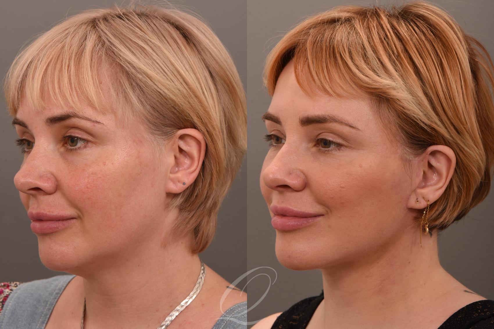 Facelift Case 1001849 Before & After Left Oblique | Serving Rochester, Syracuse & Buffalo, NY | Quatela Center for Plastic Surgery