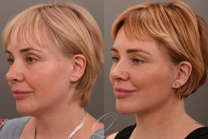 Facelift Case 1001849 Before & After Left Oblique | Serving Rochester, Syracuse & Buffalo, NY | Quatela Center for Plastic Surgery