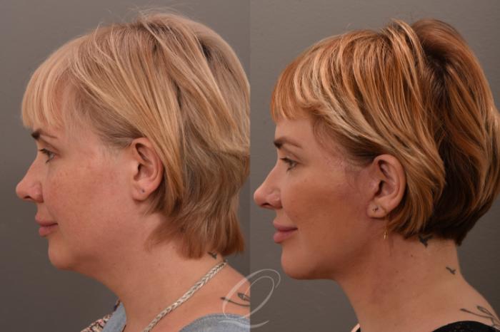 Facelift Case 1001849 Before & After Left Side | Serving Rochester, Syracuse & Buffalo, NY | Quatela Center for Plastic Surgery