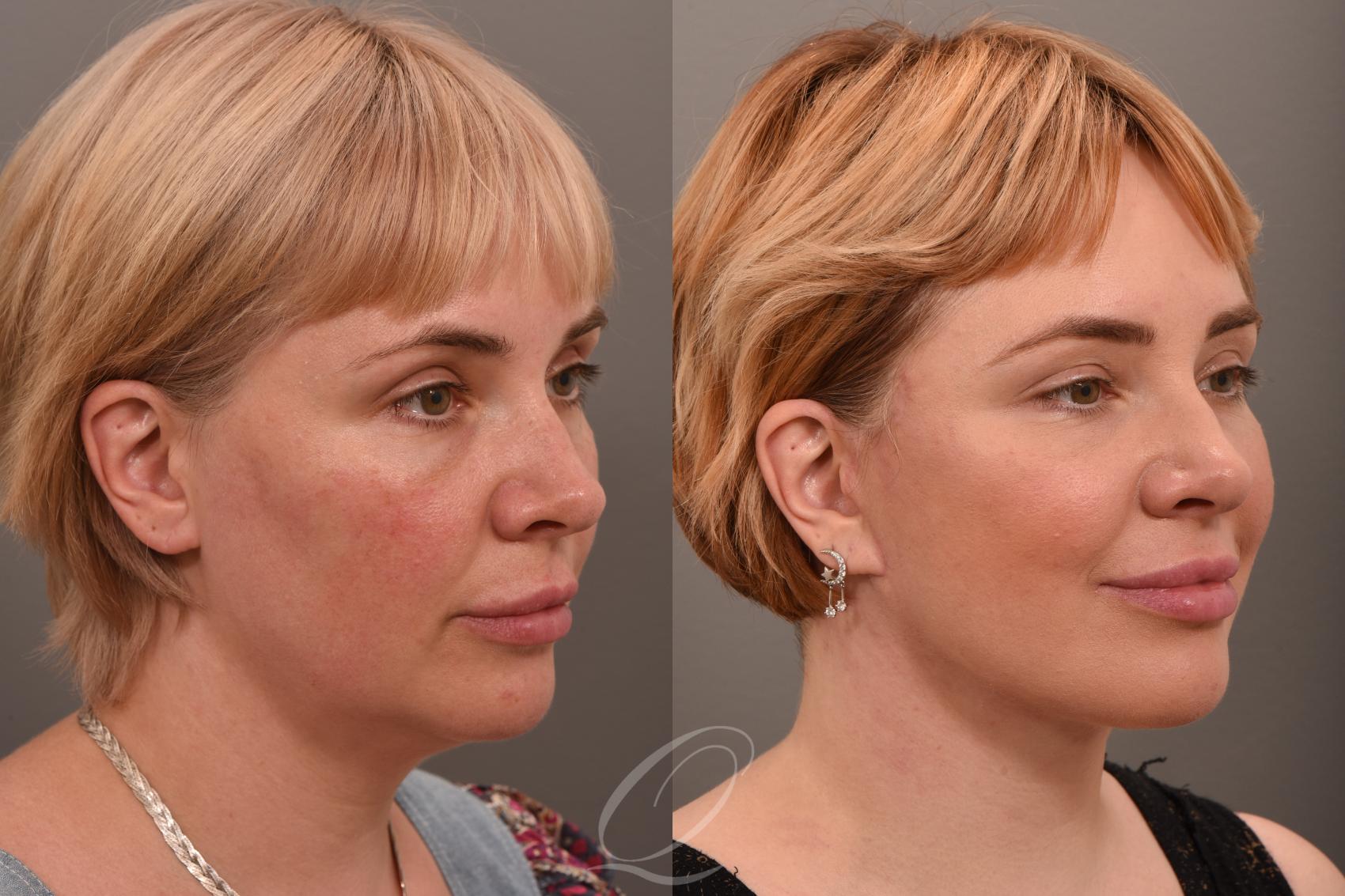 Facelift Case 1001849 Before & After Right Oblique | Serving Rochester, Syracuse & Buffalo, NY | Quatela Center for Plastic Surgery