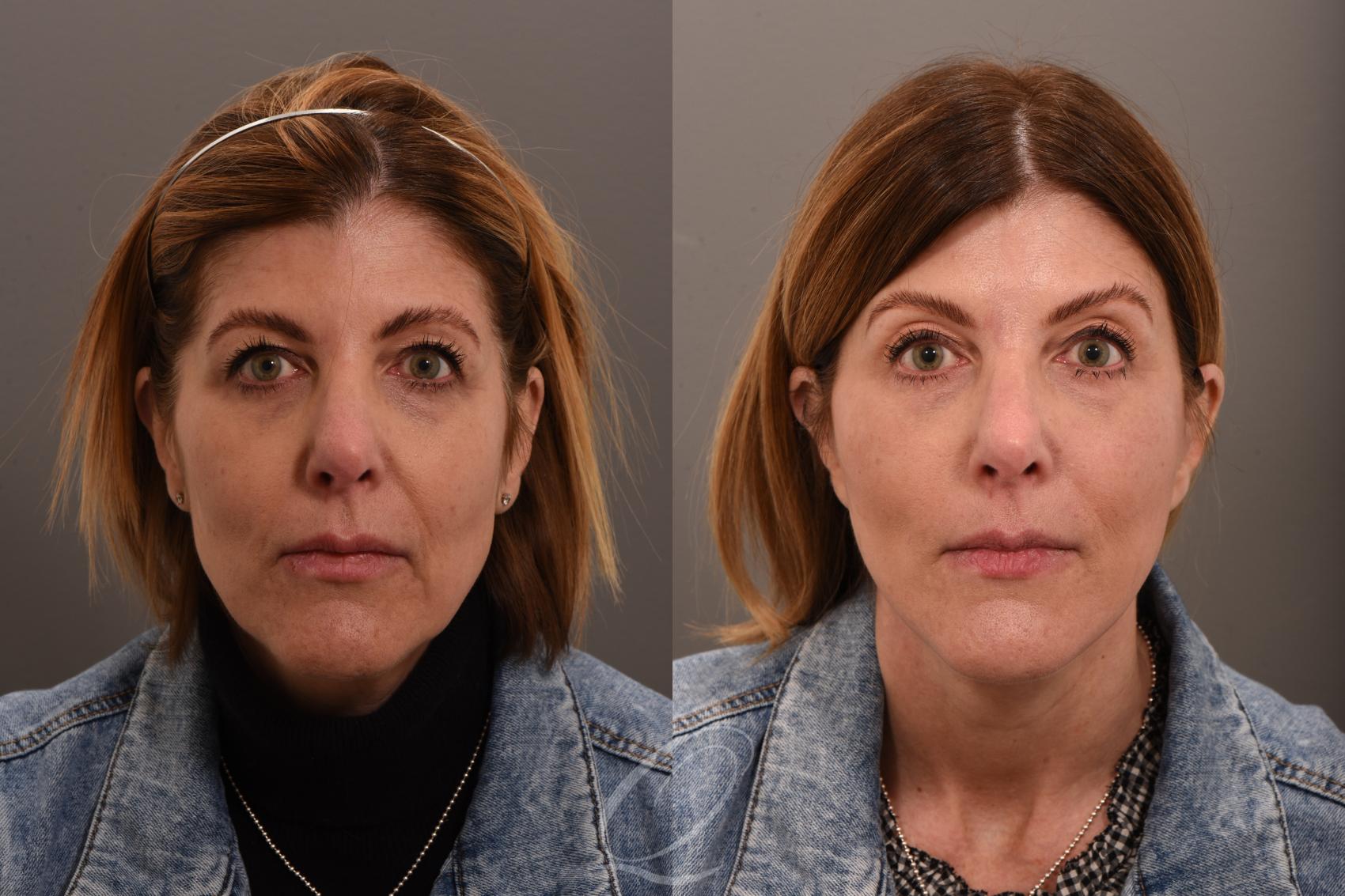 Facelift Case 1001850 Before & After Front | Serving Rochester, Syracuse & Buffalo, NY | Quatela Center for Plastic Surgery