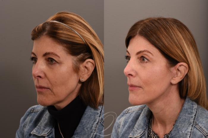 Facelift Case 1001850 Before & After Left Oblique | Serving Rochester, Syracuse & Buffalo, NY | Quatela Center for Plastic Surgery