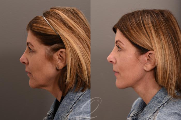 Facelift Case 1001850 Before & After Left Side | Serving Rochester, Syracuse & Buffalo, NY | Quatela Center for Plastic Surgery
