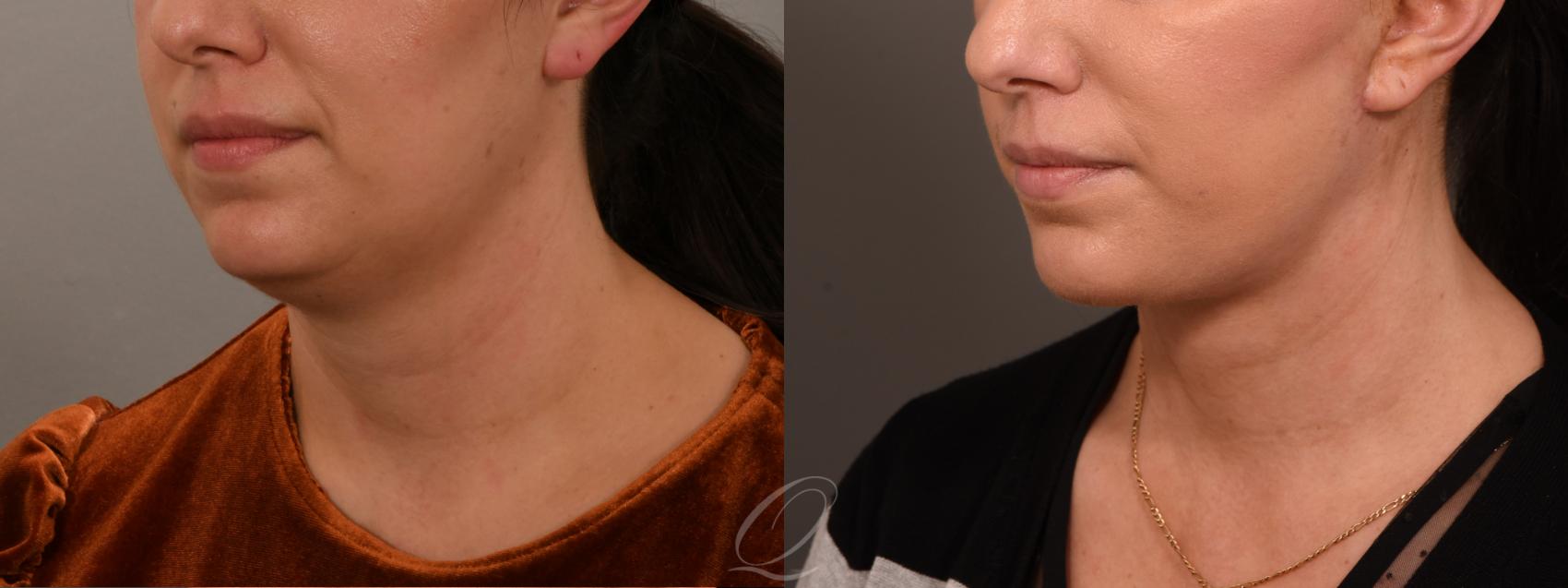 Facelift Case 1001851 Before & After Left Oblique | Serving Rochester, Syracuse & Buffalo, NY | Quatela Center for Plastic Surgery