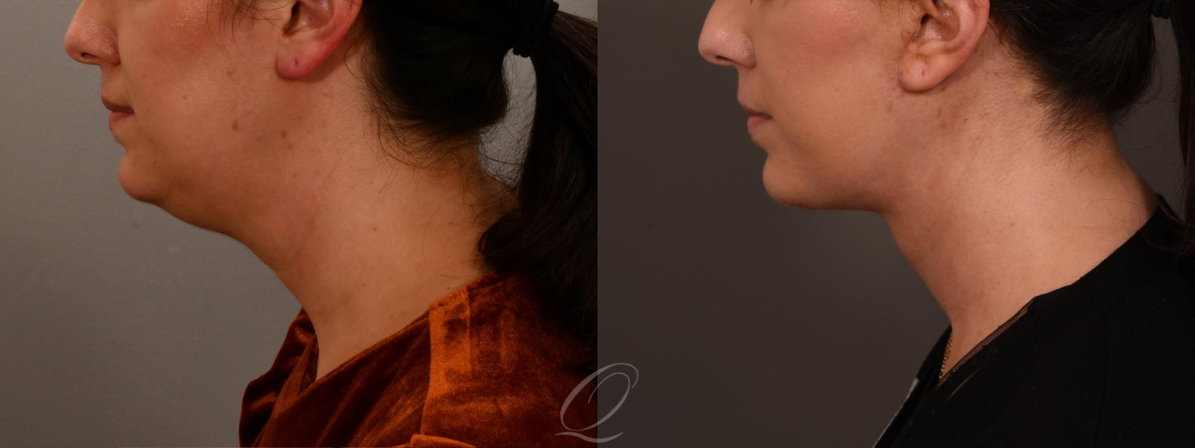 Facelift Case 1001851 Before & After Left Side | Serving Rochester, Syracuse & Buffalo, NY | Quatela Center for Plastic Surgery