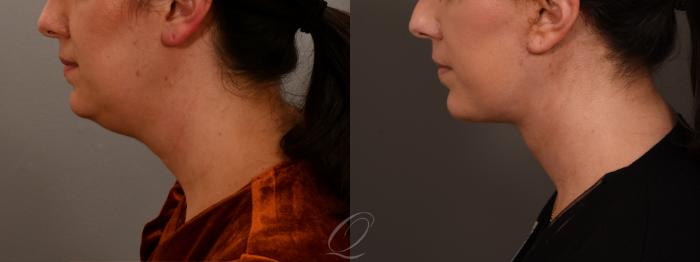 Facelift Case 1001851 Before & After Left Side | Serving Rochester, Syracuse & Buffalo, NY | Quatela Center for Plastic Surgery