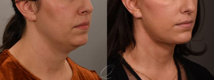 Facelift Case 1001851 Before & After Right Oblique | Serving Rochester, Syracuse & Buffalo, NY | Quatela Center for Plastic Surgery