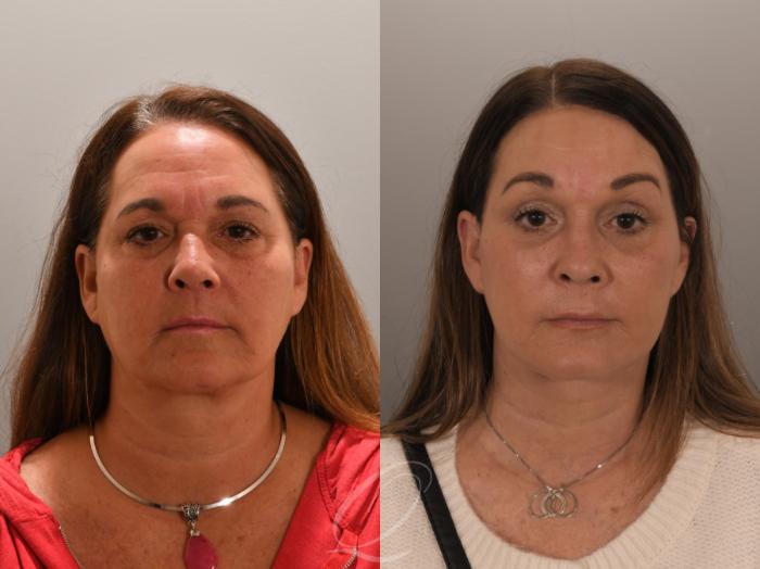Facelift Case 1001858 Before & After Front | Serving Rochester, Syracuse & Buffalo, NY | Quatela Center for Plastic Surgery