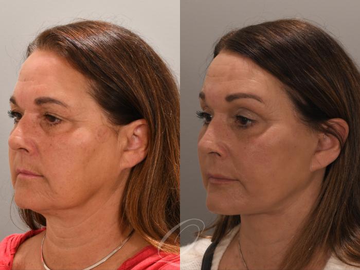 Facelift Case 1001858 Before & After Left Oblique | Serving Rochester, Syracuse & Buffalo, NY | Quatela Center for Plastic Surgery
