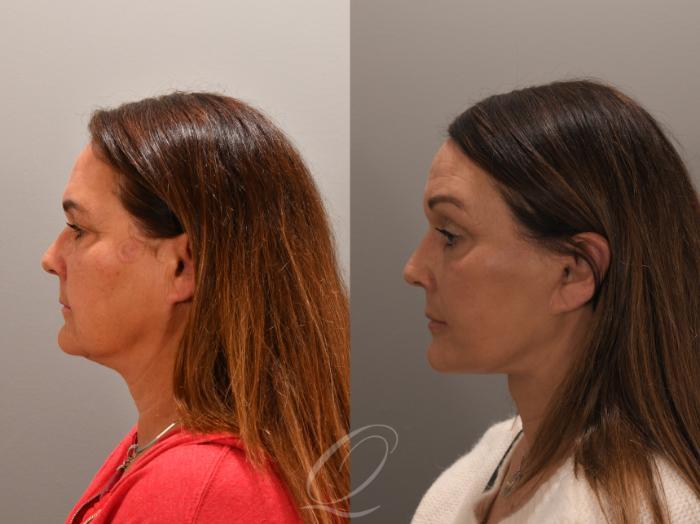 Facelift Case 1001858 Before & After Left Side | Serving Rochester, Syracuse & Buffalo, NY | Quatela Center for Plastic Surgery