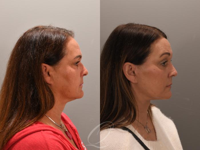 Facelift Case 1001858 Before & After Right Side | Serving Rochester, Syracuse & Buffalo, NY | Quatela Center for Plastic Surgery