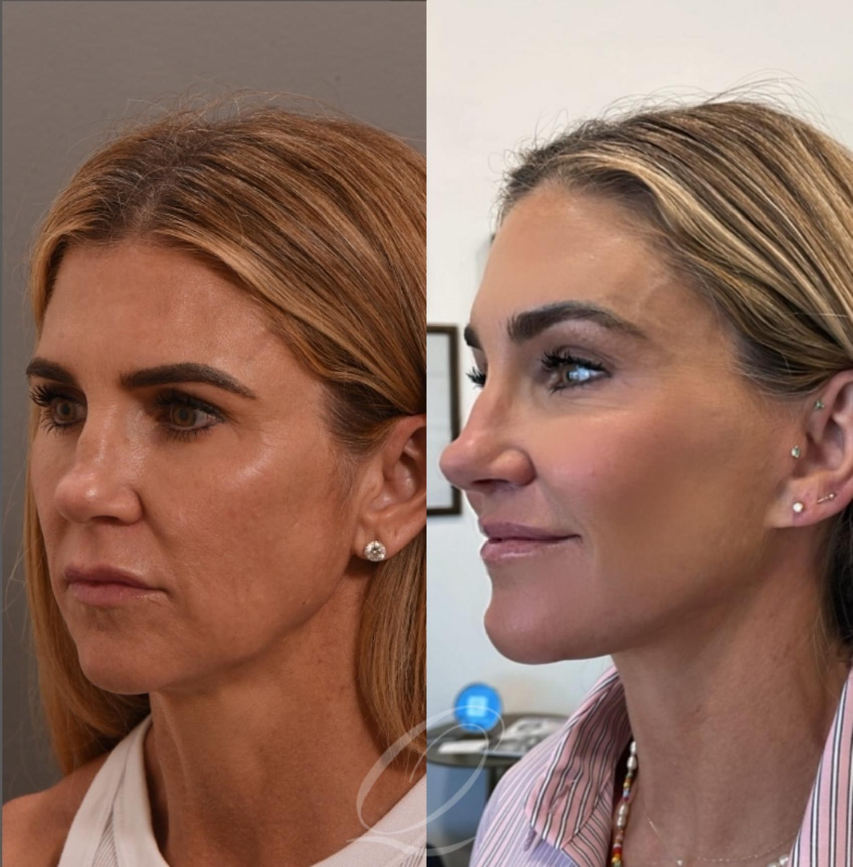 Facelift Case 1001859 Before & After Left Oblique | Serving Rochester, Syracuse & Buffalo, NY | Quatela Center for Plastic Surgery